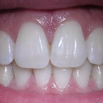 The Mammalian Teeth: Dentition and its Types