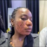“They Ruined My Skin”: Woman Exposes Skincare Clinic After Devastating Laser Treatment