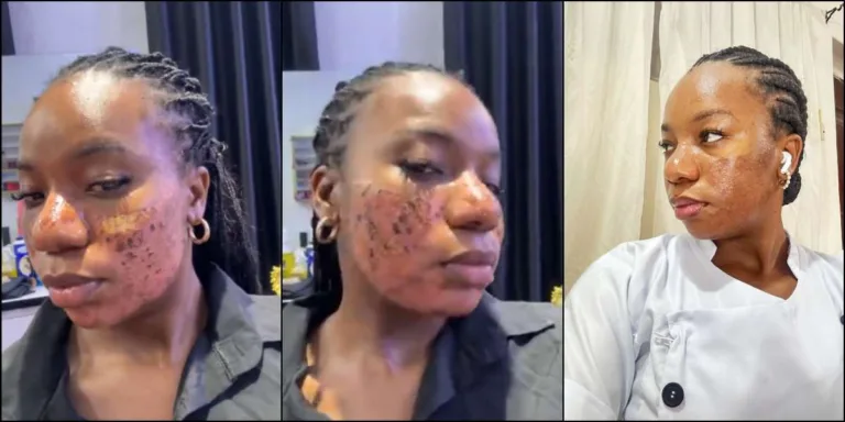 “They Ruined My Skin”: Woman Exposes Skincare Clinic After Devastating Laser Treatment