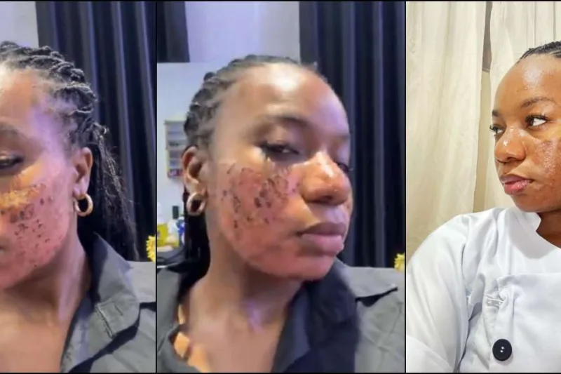 “They Ruined My Skin”: Woman Exposes Skincare Clinic After Devastating Laser Treatment