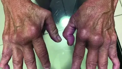 Chikungunya Cases Rise in UK as Travellers Face Increased Risk