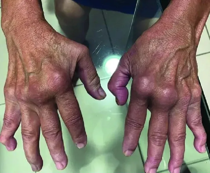 Chikungunya Cases Rise in UK as Travellers Face Increased Risk